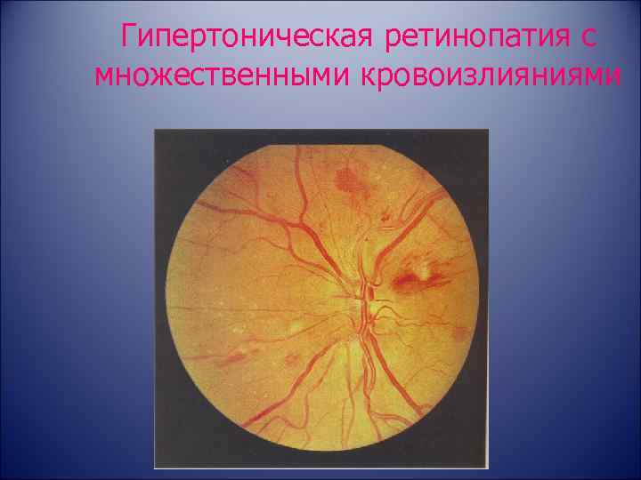 Гипертоническая ретинопатия с множественными кровоизлияниями 