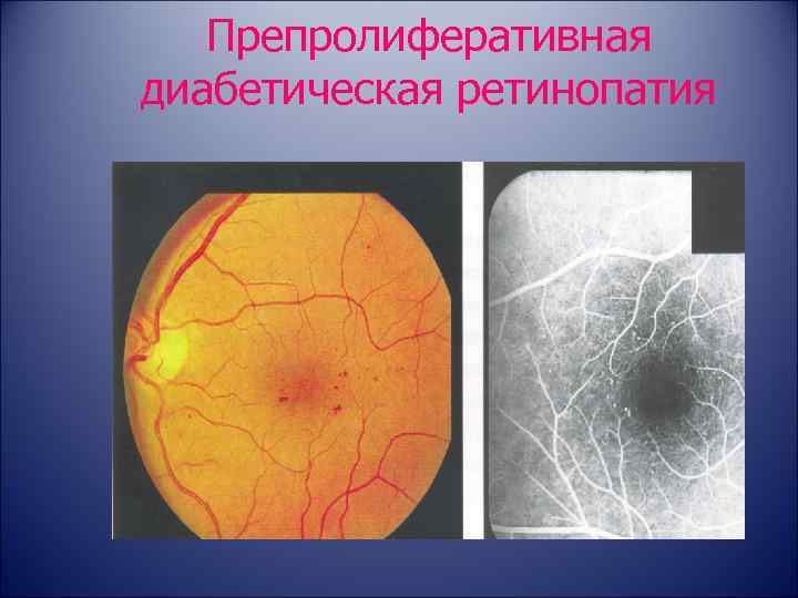 Препролиферативная диабетическая ретинопатия 