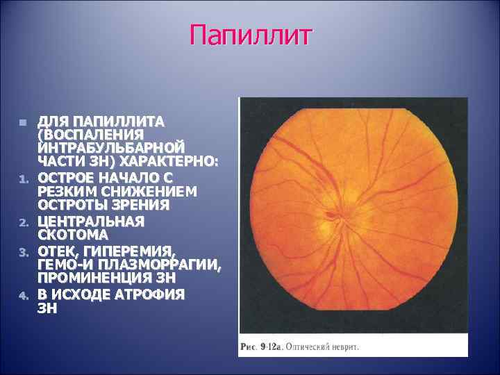 Папиллит n 1. 2. 3. 4. ДЛЯ ПАПИЛЛИТА (ВОСПАЛЕНИЯ ИНТРАБУЛЬБАРНОЙ ЧАСТИ ЗН) ХАРАКТЕРНО: ОСТРОЕ