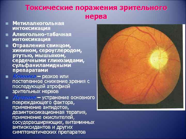 Токсические поражения зрительного нерва n n n Метилалкогольная интоксикация Алкогольно-табачная интоксикация Отравления свинцом, хинином,