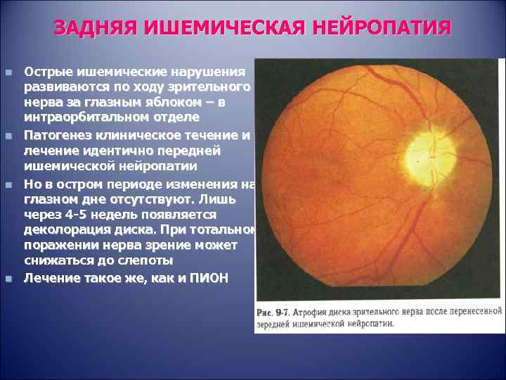 Нейропатия глаза. Передняя ишемическая нейропатия зрительного. Ишемическая оптическая нейропатия симптомы. Задняя ишемическая невропатия зрительного нерва. Ишемическая нейрооптикопатия зрительного нерва.