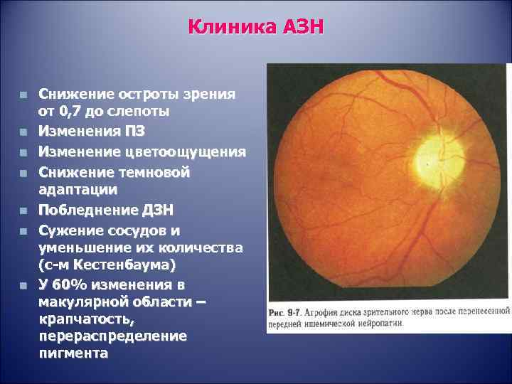 Клиника АЗН n n n n Снижение остроты зрения от 0, 7 до слепоты