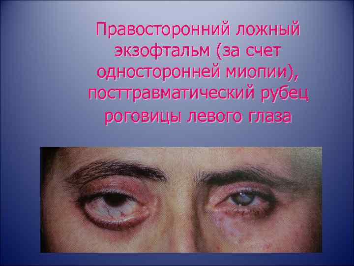 Правосторонний ложный экзофтальм (за счет односторонней миопии), посттравматический рубец роговицы левого глаза 