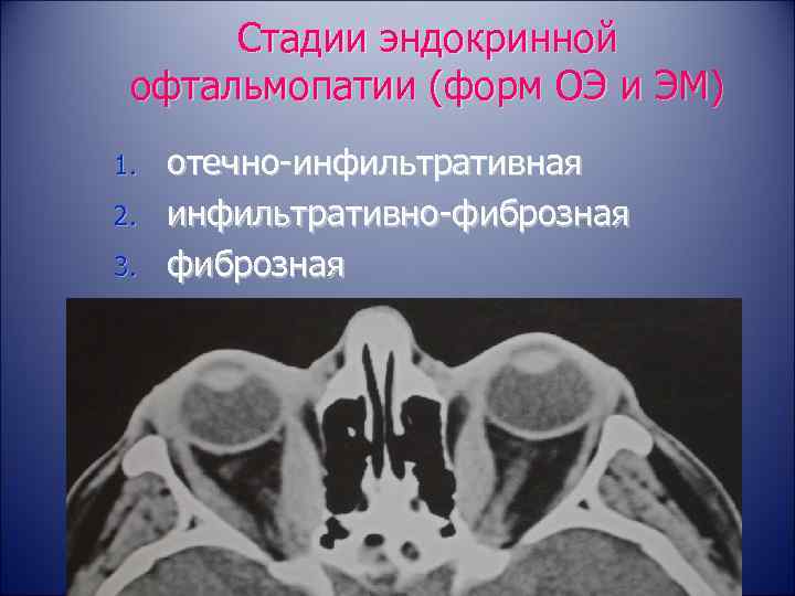 Стадии эндокринной офтальмопатии (форм ОЭ и ЭМ) 1. 2. 3. отечно-инфильтративная инфильтративно-фиброзная 