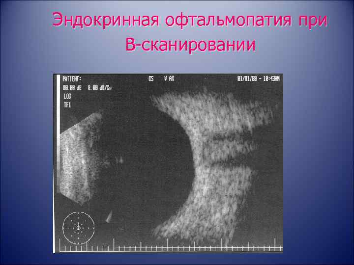 Эндокринная офтальмопатия при В-сканировании 