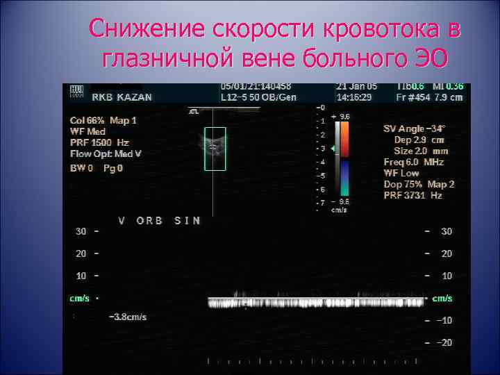 Снижение скорости кровотока в глазничной вене больного ЭО 