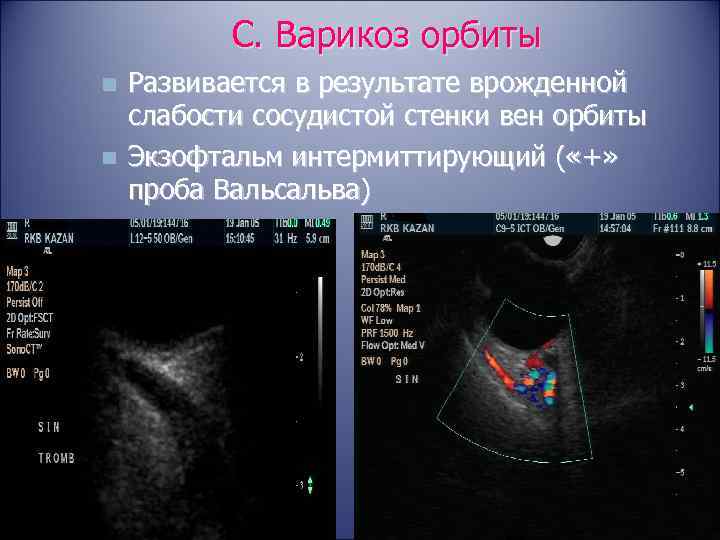 С. Варикоз орбиты n n Развивается в результате врожденной слабости сосудистой стенки вен орбиты