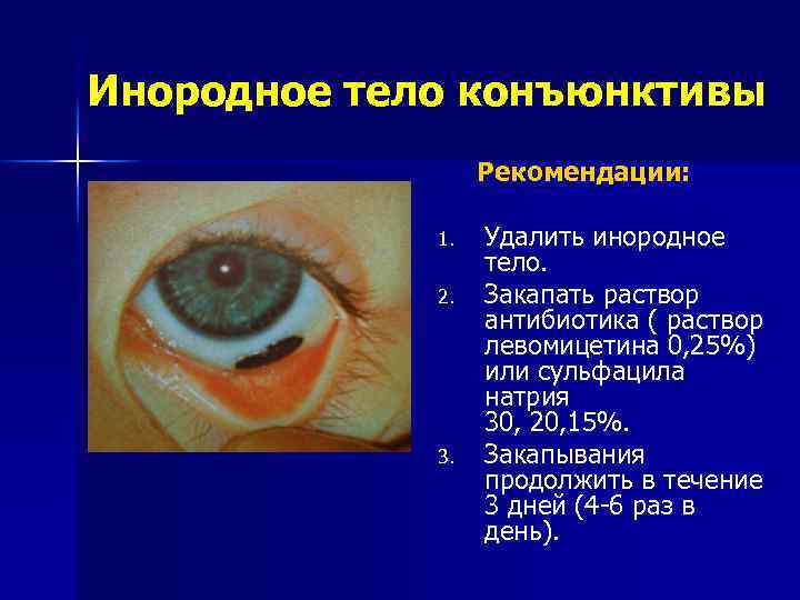 Инородное тело конъюнктивы Рекомендации: 1. 2. 3. Удалить инородное тело. Закапать раствор антибиотика (