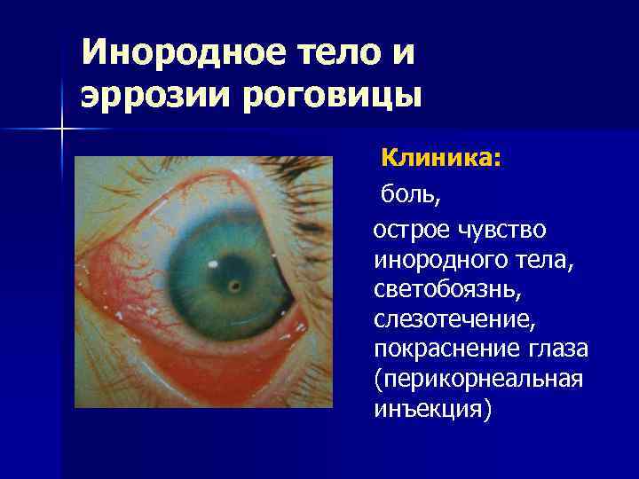 Инородное тело и эррозии роговицы Клиника: боль, острое чувство инородного тела, светобоязнь, слезотечение, покраснение