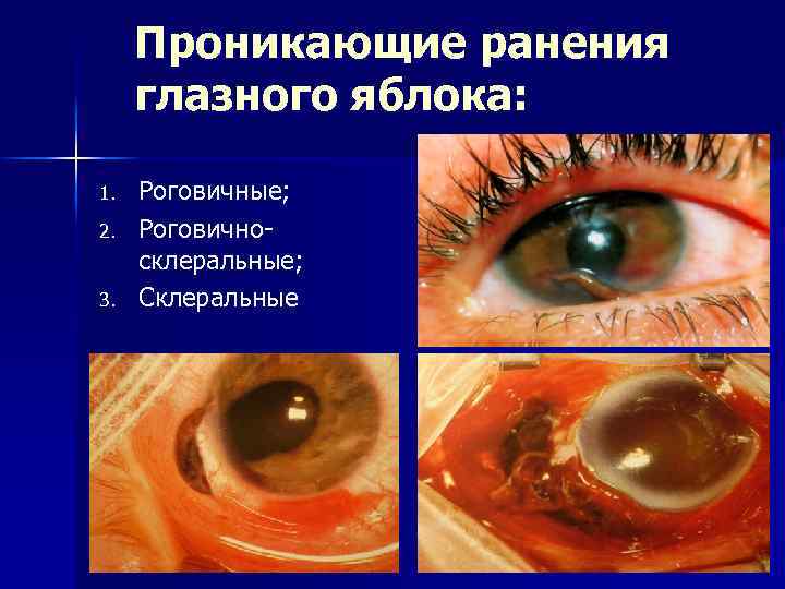Проникающие ранения глазного яблока: 1. 2. 3. Роговичные; Роговичносклеральные; Склеральные 