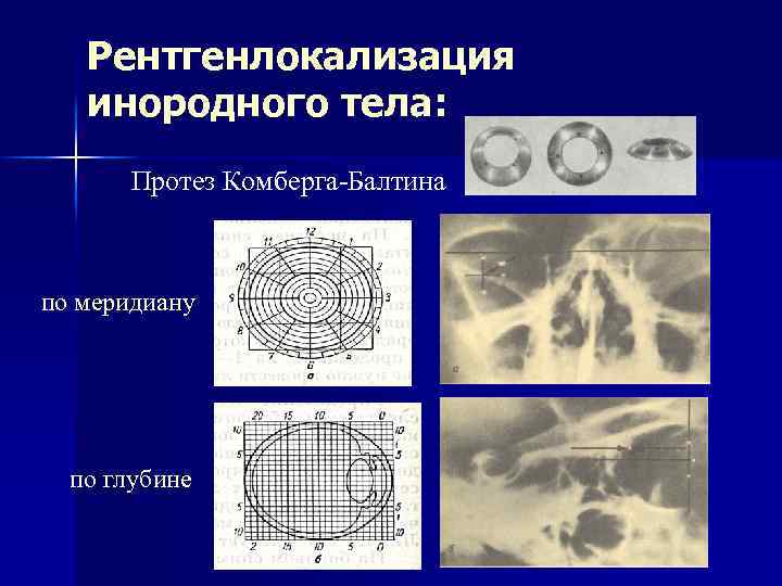 Рентгенлокализация инородного тела: Протез Комберга-Балтина по меридиану по глубине 