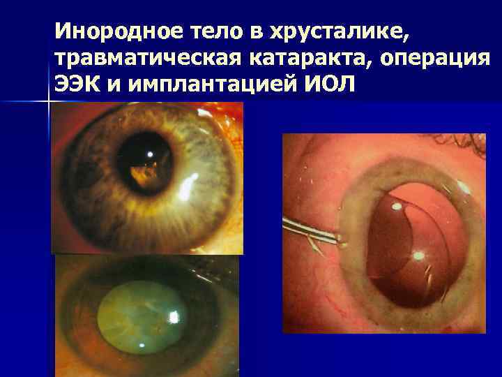Инородное тело в хрусталике, травматическая катаракта, операция ЭЭК и имплантацией ИОЛ 