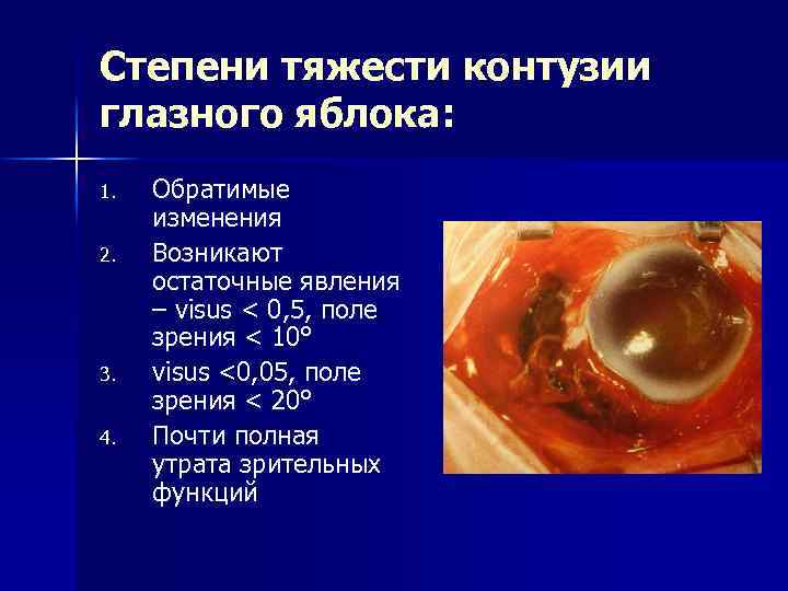 Степени тяжести контузии глазного яблока: 1. 2. 3. 4. Обратимые изменения Возникают остаточные явления