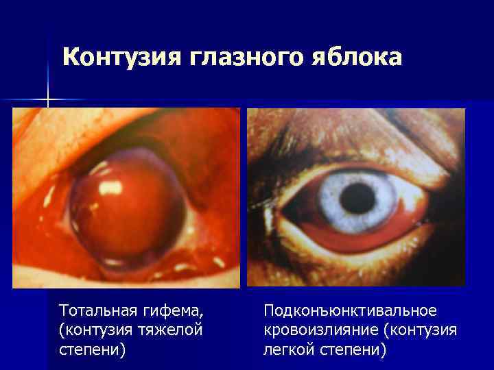 Контузия глазного яблока Тотальная гифема, (контузия тяжелой степени) Подконъюнктивальное кровоизлияние (контузия легкой степени) 
