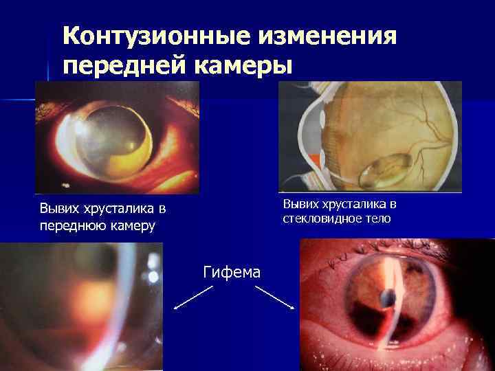 Контузионные изменения передней камеры Вывих хрусталика в стекловидное тело Вывих хрусталика в переднюю камеру