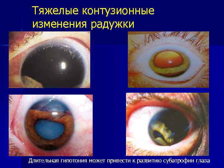 Тяжелые контузионные изменения радужки Длительная гипотония может привести к развитию субатрофии глаза 
