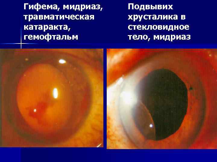 Гифема, мидриаз, травматическая катаракта, гемофтальм Подвывих хрусталика в стекловидное тело, мидриаз 