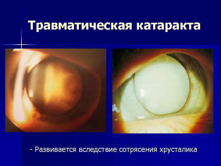 Травматическая катаракта - Развивается вследствие сотрясения хрусталика 