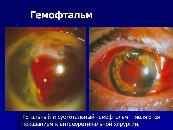 Гемофтальм Тотальный и субтотальный гемофтальм – являются показанием к витреоретинальной хирургии. 