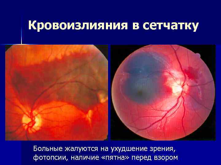 Кровоизлияния в сетчатку Больные жалуются на ухудшение зрения, фотопсии, наличие «пятна» перед взором 