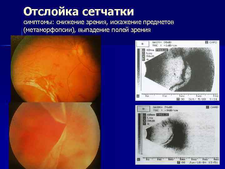 Отслойка сетчатки симптомы: снижение зрения, искажение предметов (метаморфопсии), выпадение полей зрения 