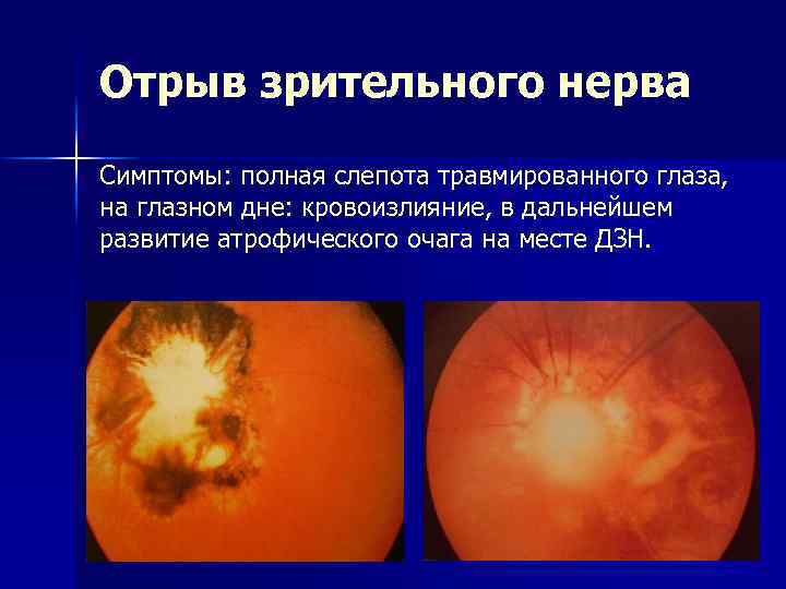 Отрыв зрительного нерва Симптомы: полная слепота травмированного глаза, на глазном дне: кровоизлияние, в дальнейшем