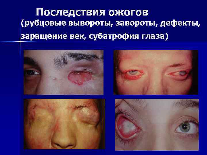 Последствия ожогов (рубцовые вывороты, завороты, дефекты, заращение век, субатрофия глаза) 