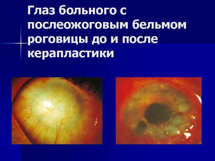 Глаз больного с послеожоговым бельмом роговицы до и после керапластики 