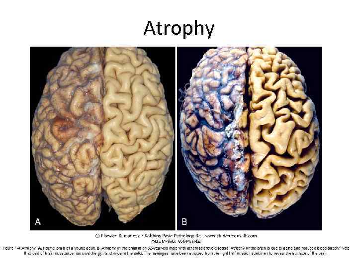 Atrophy 