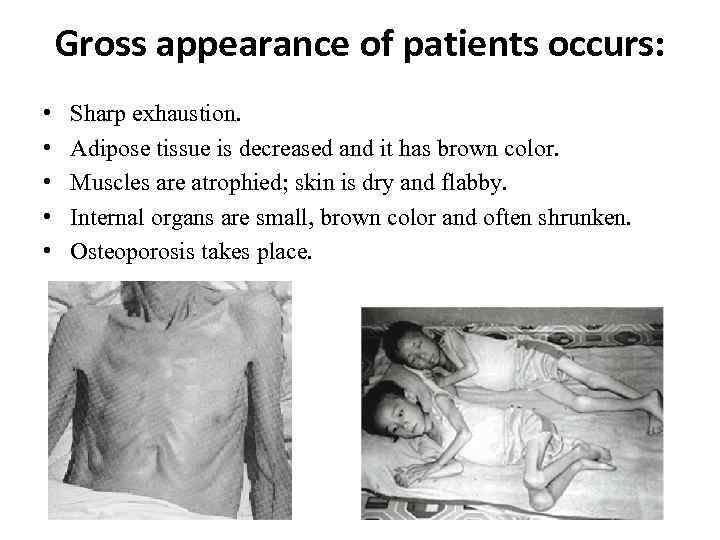 Gross appearance of patients occurs: • • • Sharp exhaustion. Adipose tissue is decreased