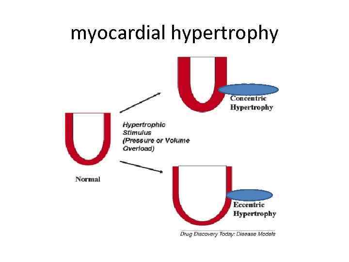 myocardial hypertrophy 