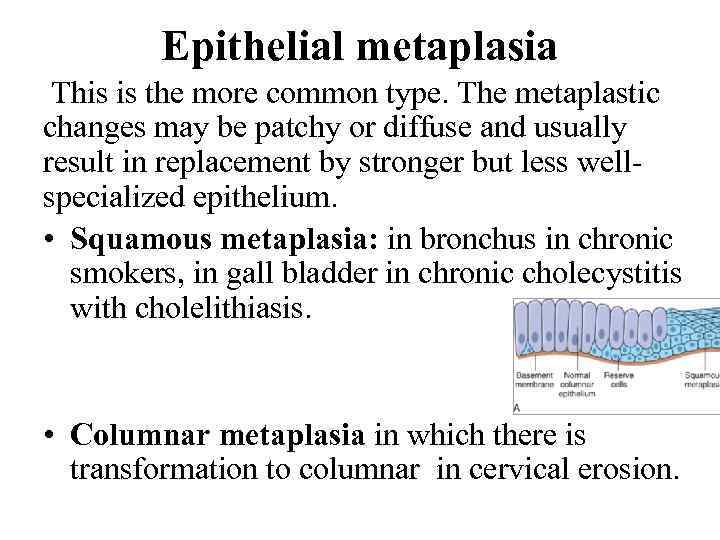 Epithelial metaplasia This is the more common type. The metaplastic changes may be patchy