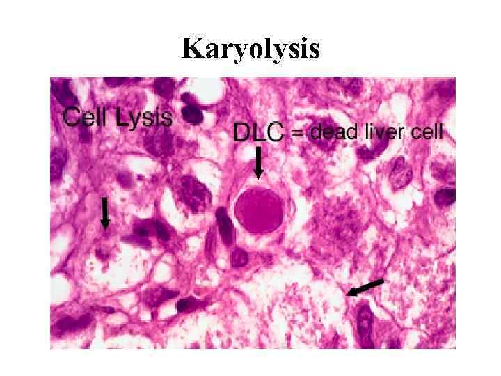 Karyolysis 