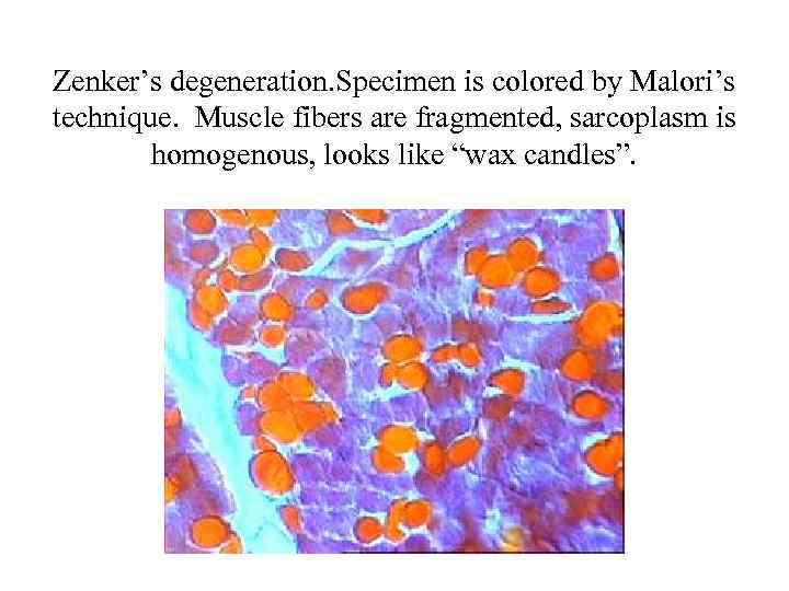 Zenker’s degeneration. Specimen is colored by Malori’s technique. Muscle fibers are fragmented, sarcoplasm is