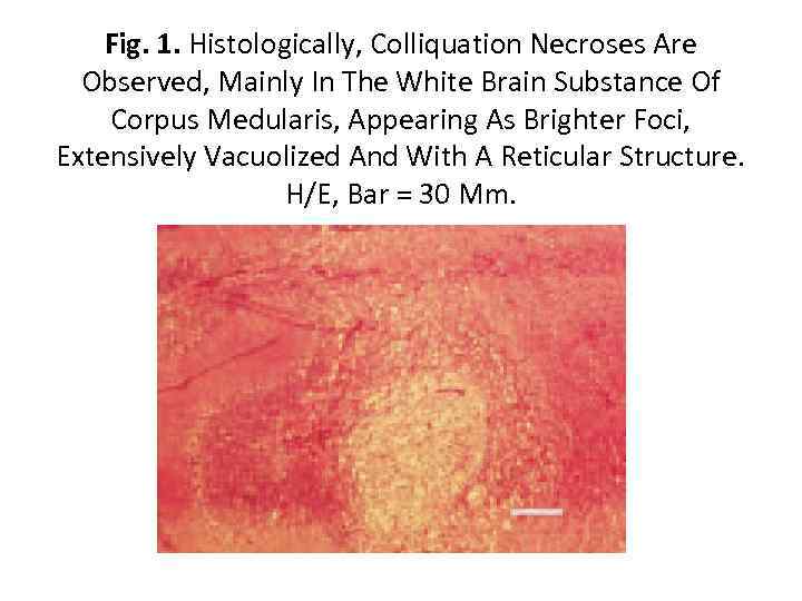 Fig. 1. Histologically, Colliquation Necroses Are Observed, Mainly In The White Brain Substance Of