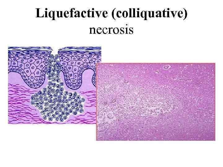 Liquefactive (colliquative) necrosis 