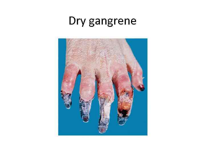 Dry gangrene 