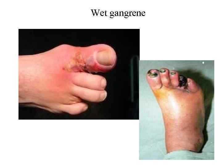 Wet gangrene 