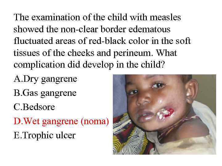 The examination of the child with measles showed the non-clear border edematous fluctuated areas