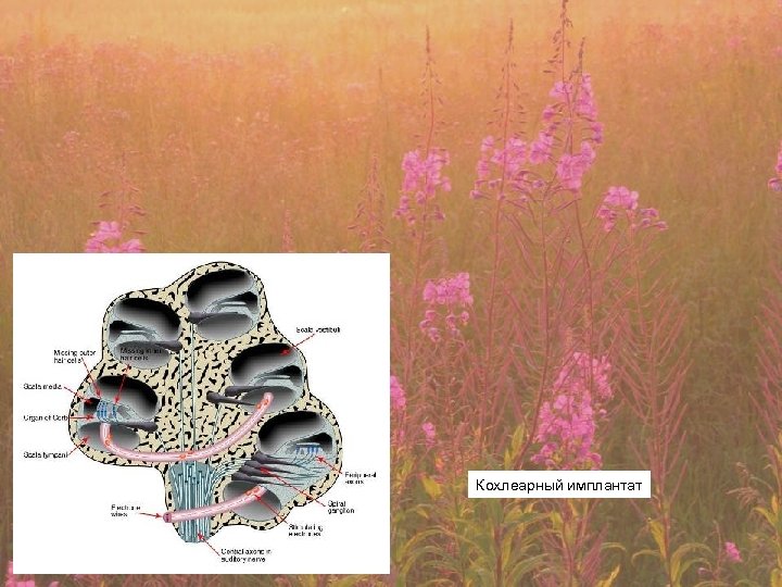 Кохлеарный имплантат 