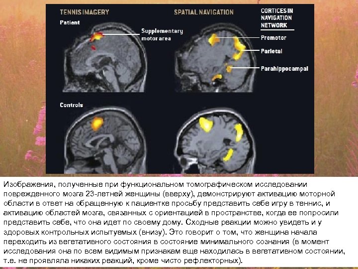 Изображения, полученные при функциональном томографическом исследовании поврежденного мозга 23 -летней женщины (вверху), демонстрируют активацию