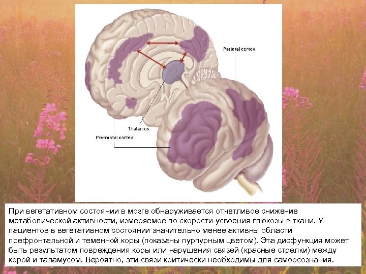 При вегетативном состоянии в мозге обнаруживается отчетливое снижение метаболической активности, измеряемое по скорости усвоения