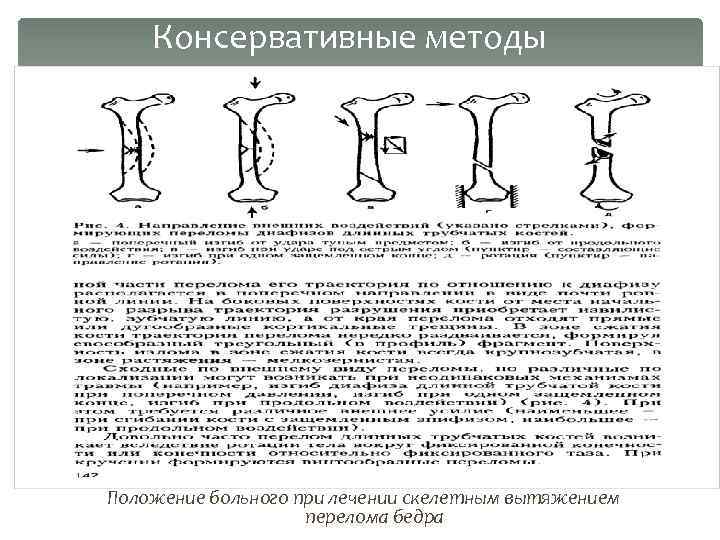 Консервативные методы Положение больного при лечении скелетным вытяжением перелома бедра 