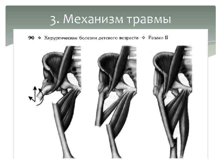 3. Механизм травмы 