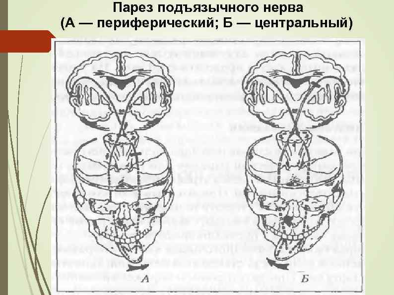 Парез подъязычного нерва (А — периферический; Б — центральный) 