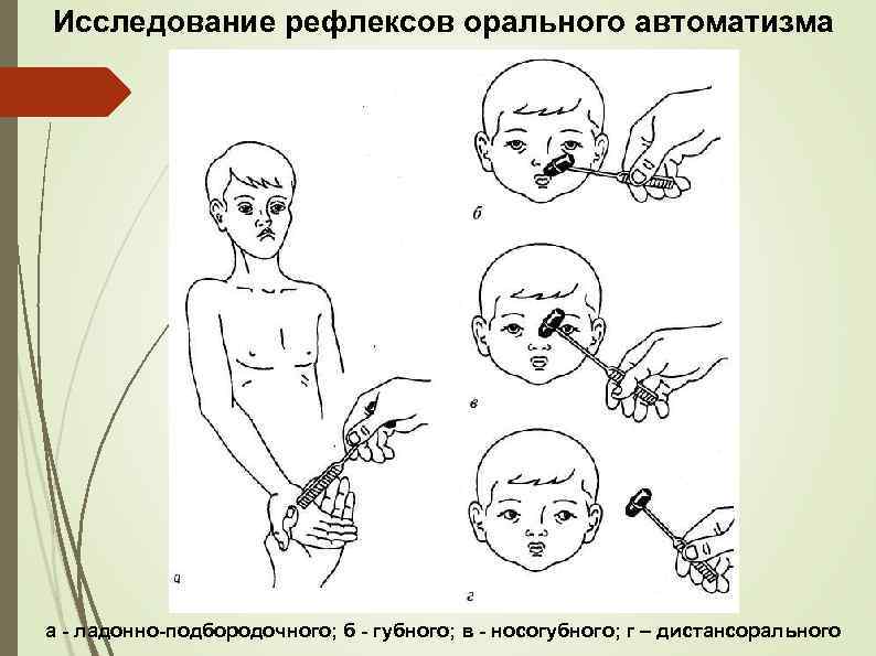 Исследование рефлексов орального автоматизма а - ладонно-подбородочного; б - губного; в - носогубного; г