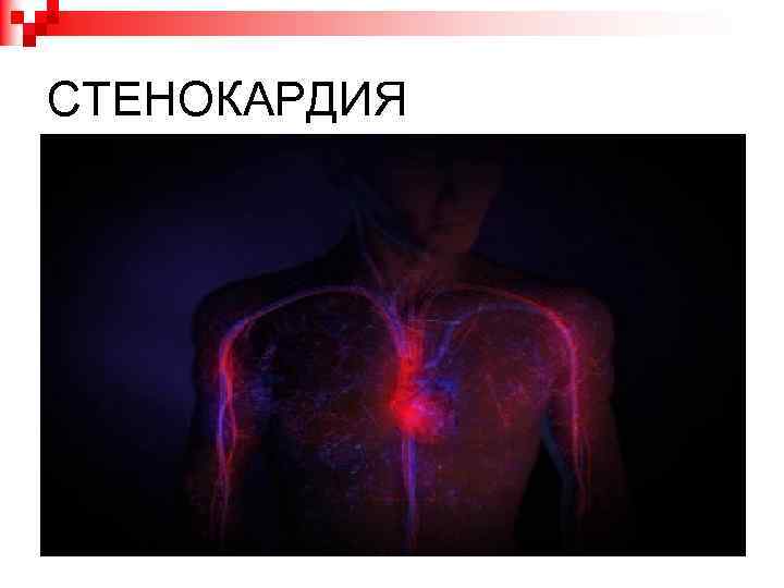 СТЕНОКАРДИЯ 
