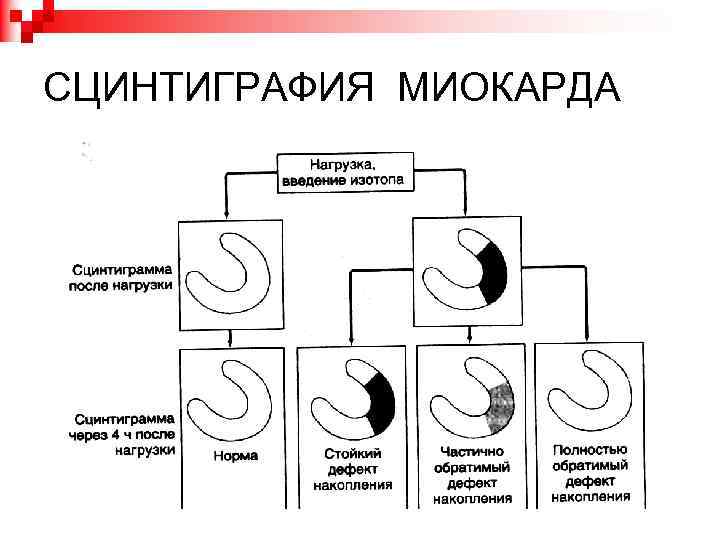 Презентация сцинтиграфия миокарда