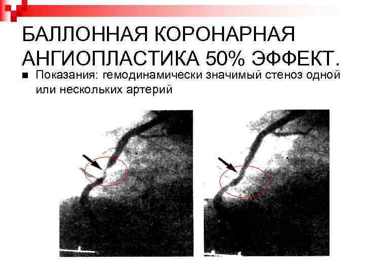 БАЛЛОННАЯ КОРОНАРНАЯ АНГИОПЛАСТИКА 50% ЭФФЕКТ. Показания: гемодинамически значимый стеноз одной или нескольких артерий 