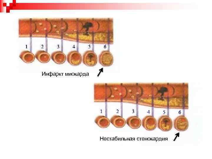 Инфаркт миокарда Нестабильная стенокардия 